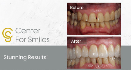 When do you need Dental fillers? – Community Smiles